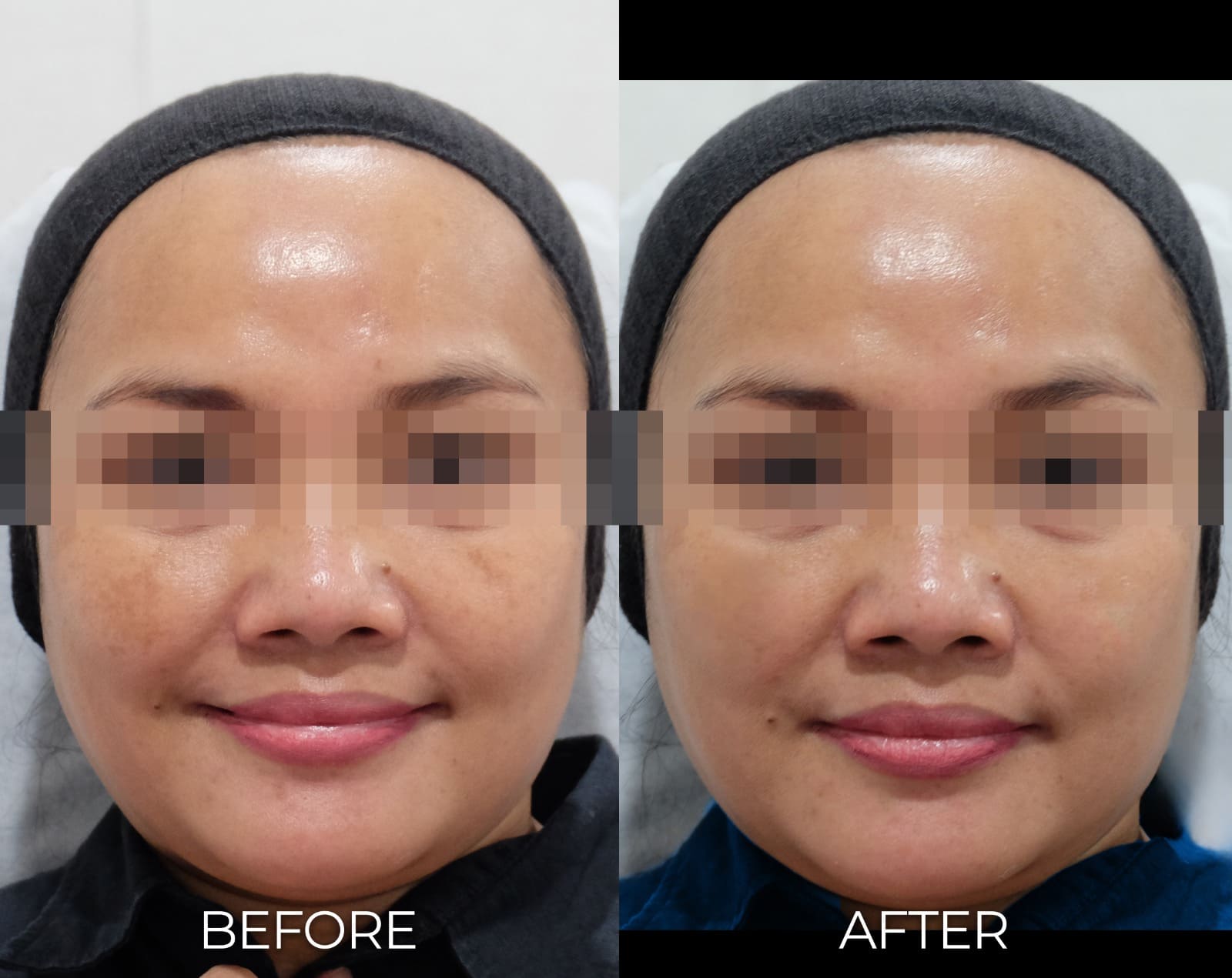 BA PICO LASER OK NEWEST 1