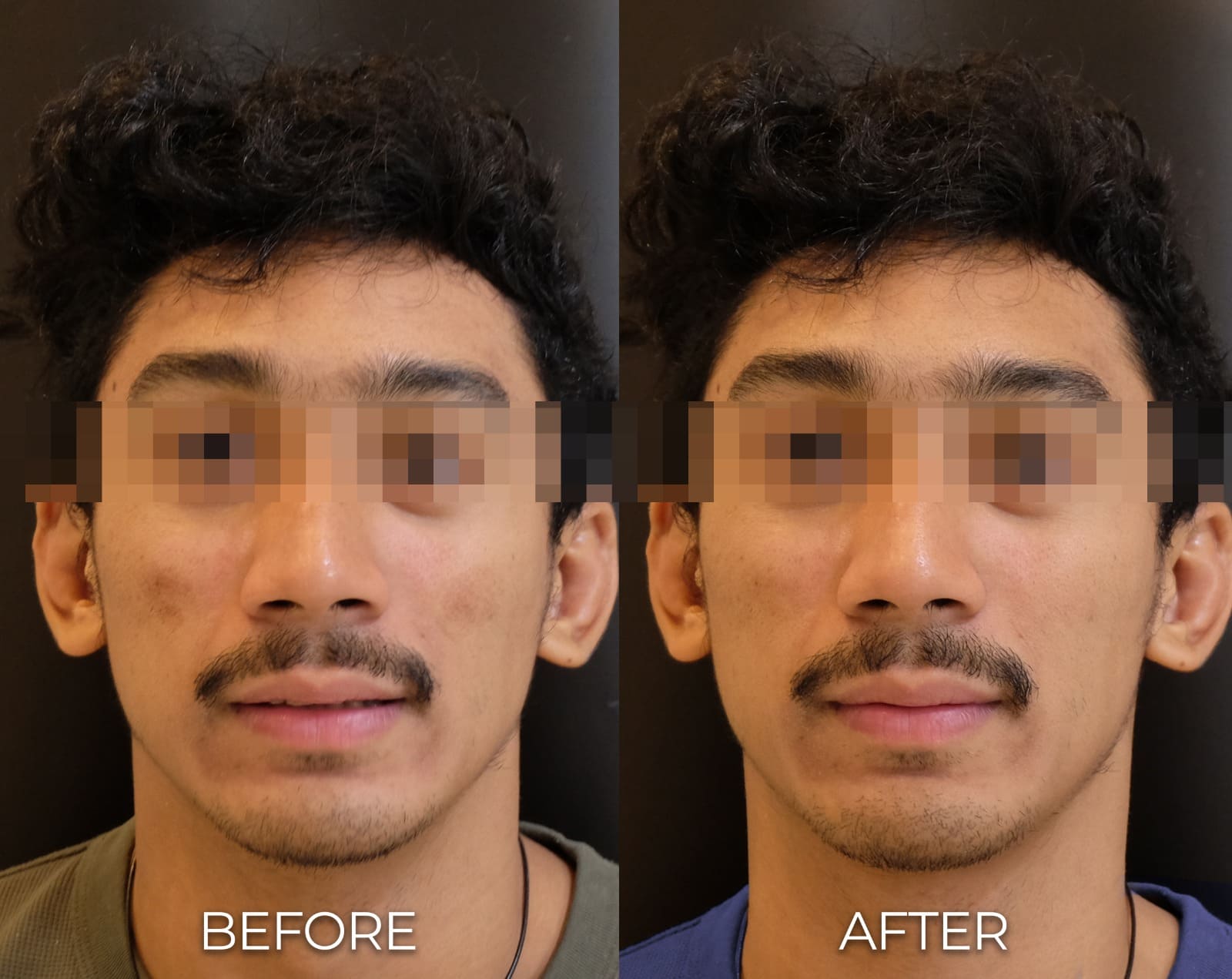 BA PICO LASER OK NEWEST 2