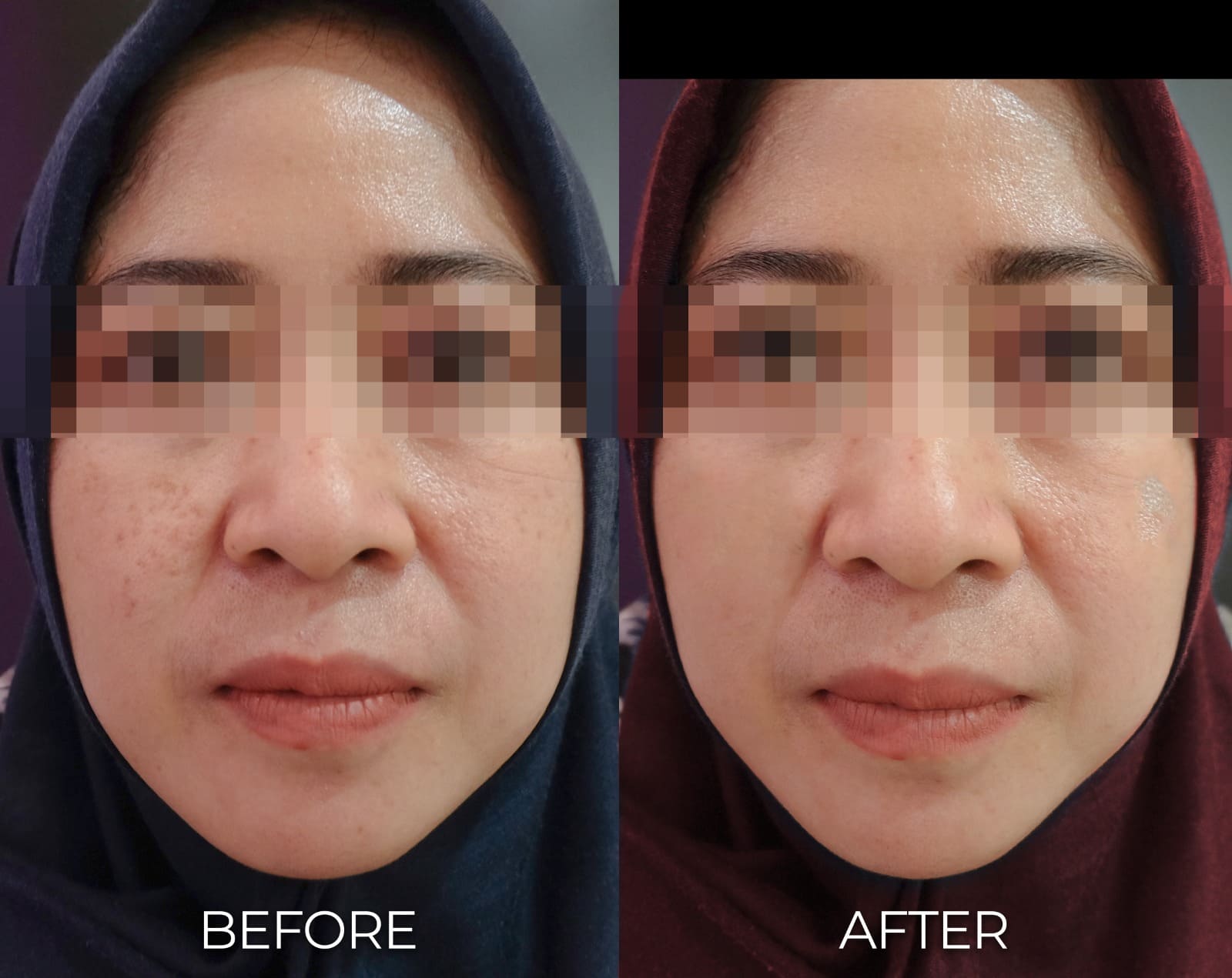 BA PICO LASER OK NEWEST 3