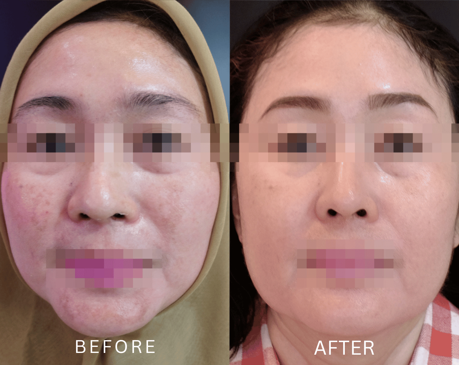 Before After Pico Laser Real 4