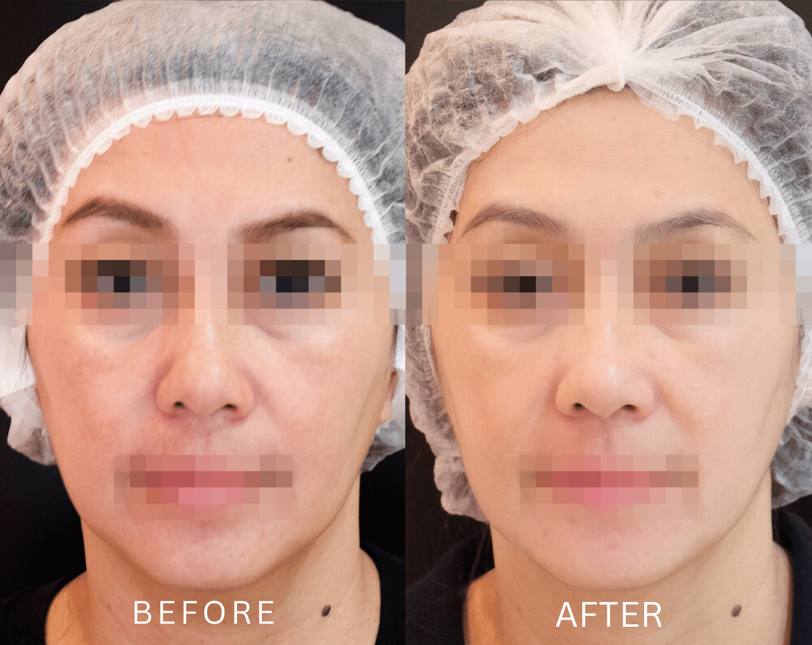 Before After Pico Laser Real 5